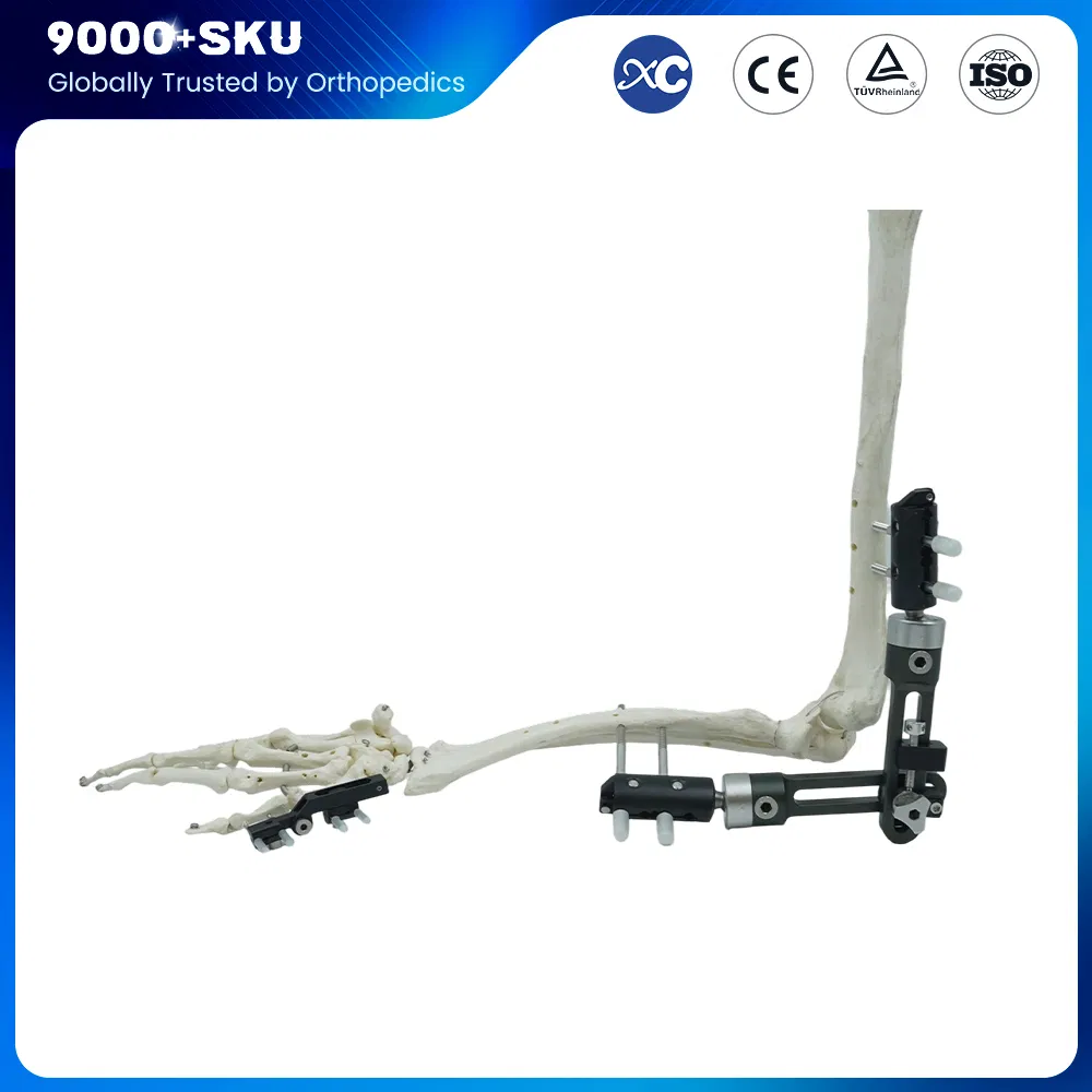 Orthopedic Medical Fracture Fixation Single-Pin Type Upper Limbs Wrist External Fixator