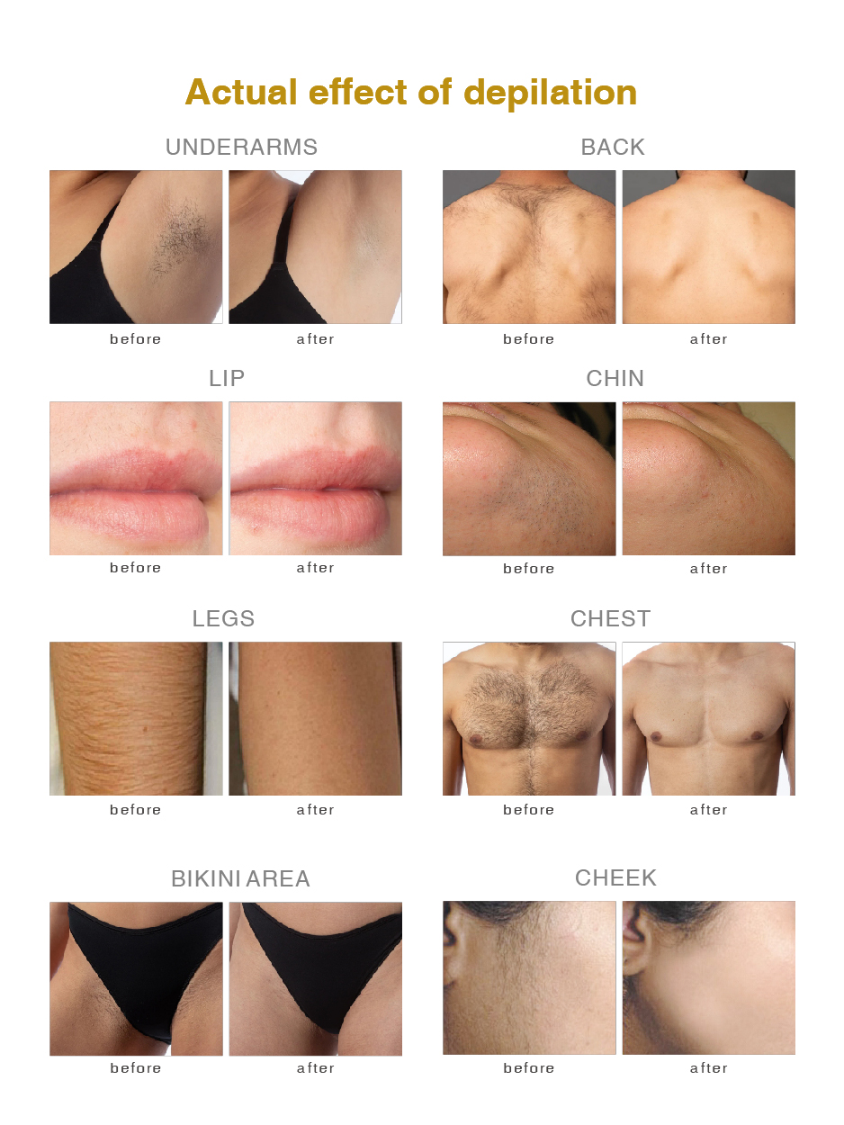 Laser Bar technology details