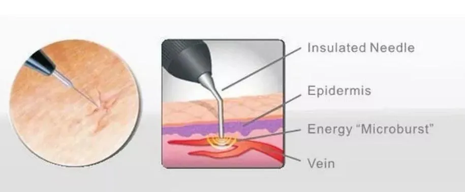 High Frequency Vascular Removal Treatment Diagram