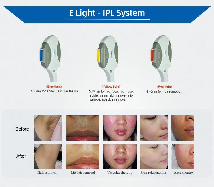 High Output Power Portable IPL Hair Removal Device Display 3