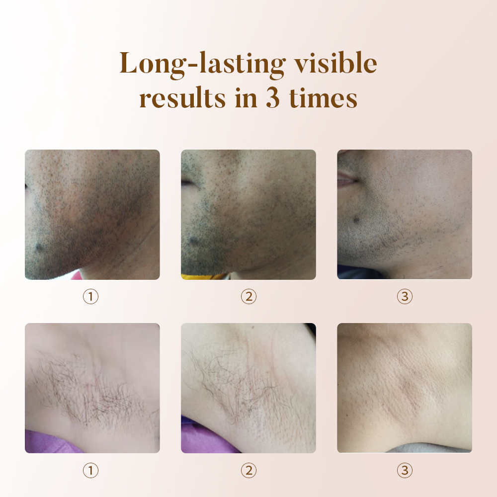 Leaflife Best Home Use Led Laser Hair Removal Device with 100 Million Shots Whole Body &amp; Facial Painless Hair Removal at Home