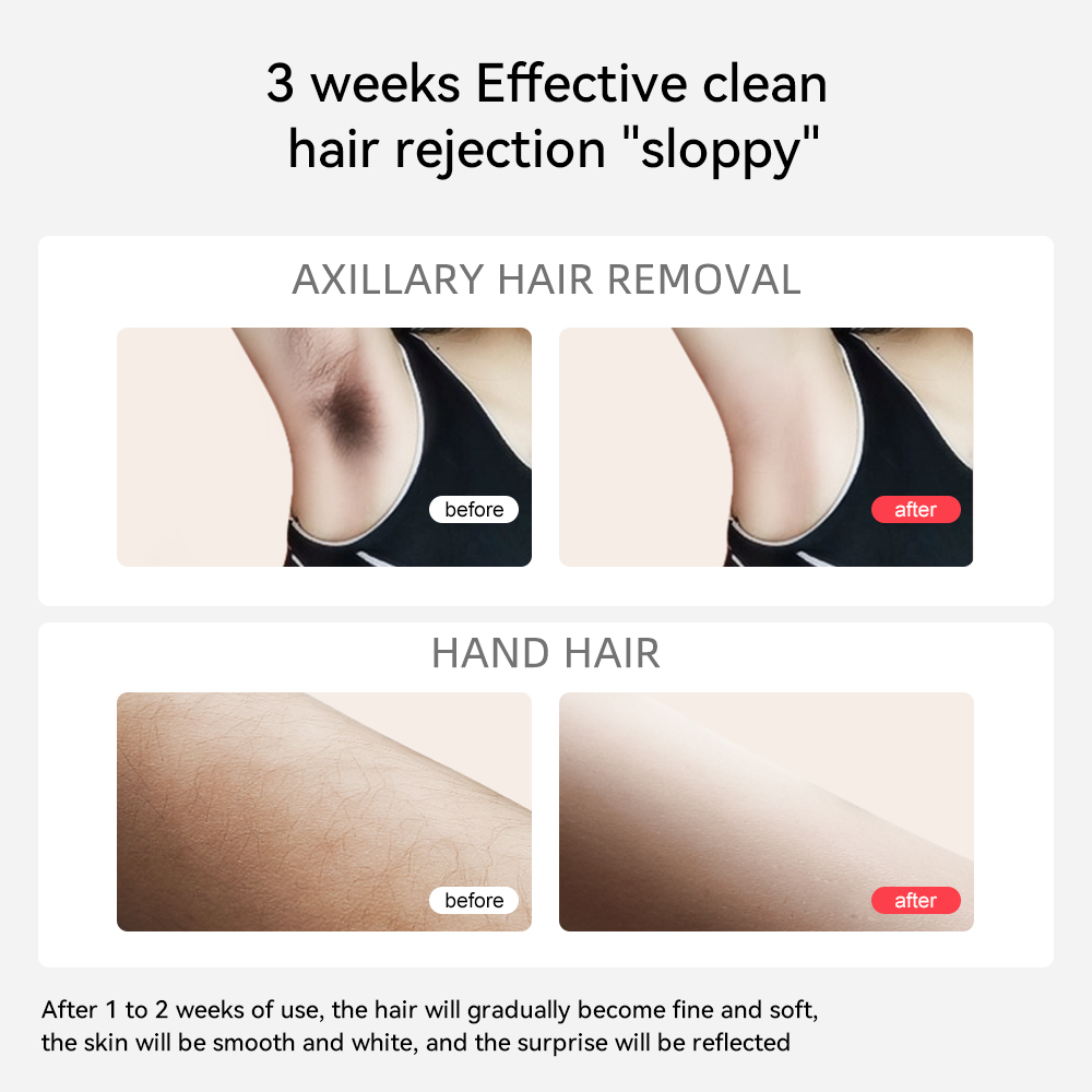 Sapphire IPL Hair Removal Device - 9&deg;C Cooling Tech Smart LCD Display 3 Cleared Replaceable Heads Painless Hair Reduction