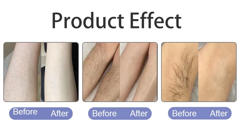 Newest Triple Wavelength Diode Laser Hair Removal with Factory Price 808nm Hair Removal Machine IPL Hair Removal Laser Machine