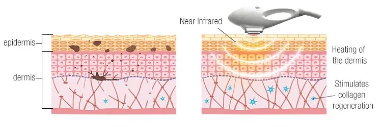Skin Rejuvenation Treatment Effect Illustration