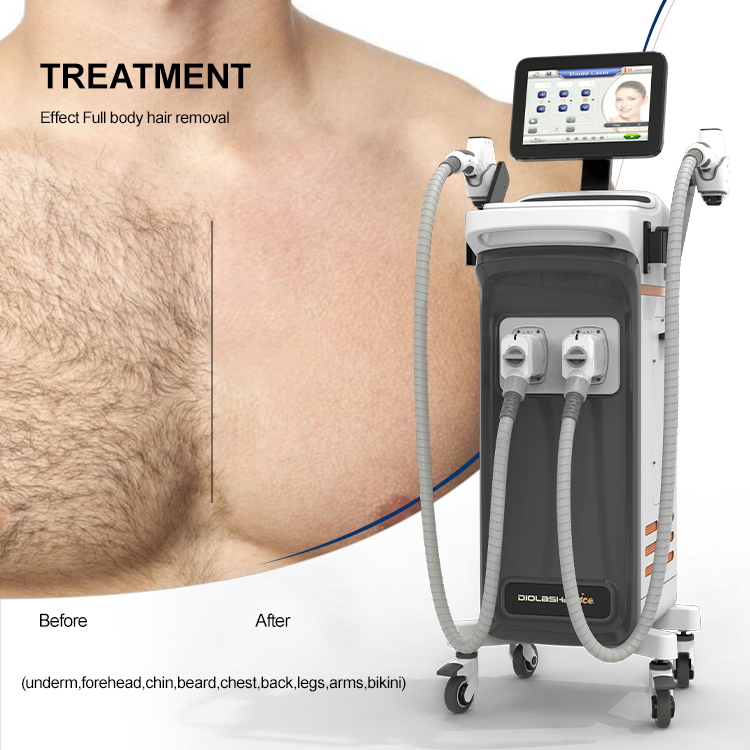 Nubway 2000w 755nm 808nm 1064 Nm Depilation 20HZ Ultra-Fast Frequency Diode Laser Hair Removal Machine Spa Use