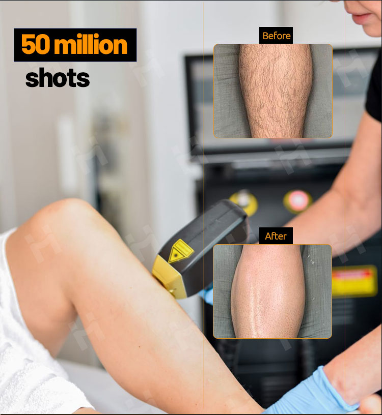 Laser hair removal Clinical Before and After