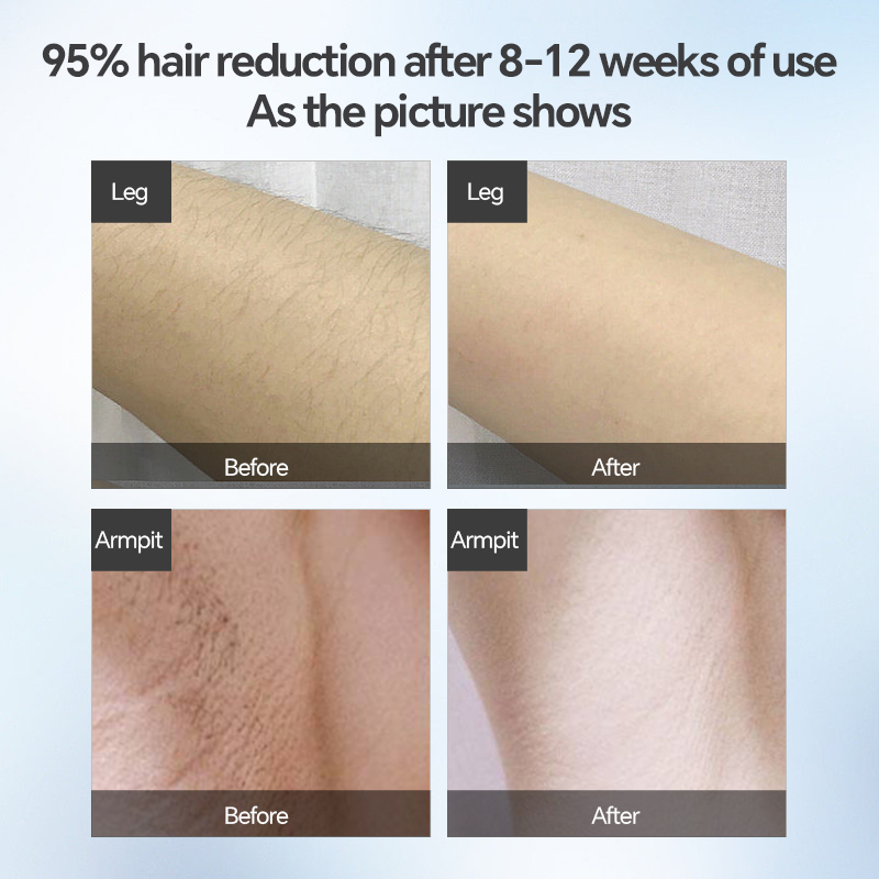 Mlay T10 High Quality Portable Smart Hair Removal Laser Unlimited Flashes With Sapphire Ice Cooling IPL Hair Removal for Home