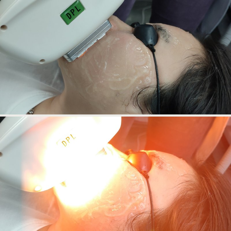 -25c Sapphire Cooling Dpl IPL Device for Non-Surgical Face Lifting