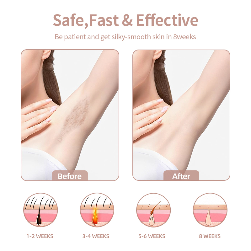 Ice Cooling 3 in 1 Painless Photoepilator Permanent Whole Body Treatment IPL Laser Hair Removal Device at Home for Men and Women