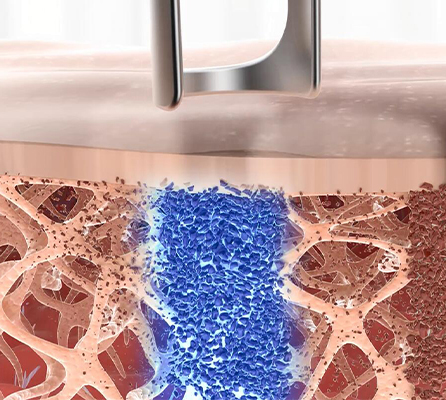 Pico Laser Technology