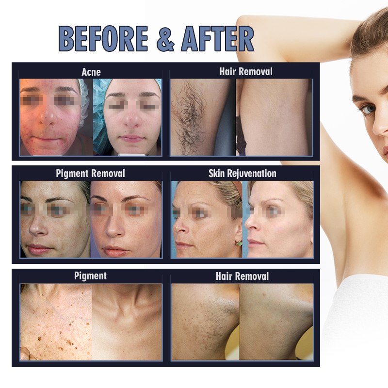 Portable IPL Laser Hair Removal Machine Machine Pigment Therapy Acne Spot Removal