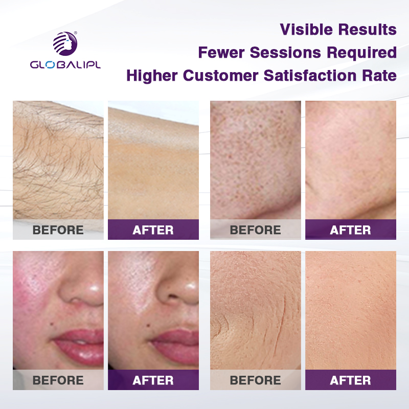 Professional Dpl Ipl Opt Laser Hair Removal Photorejuvenation Beauty Machine