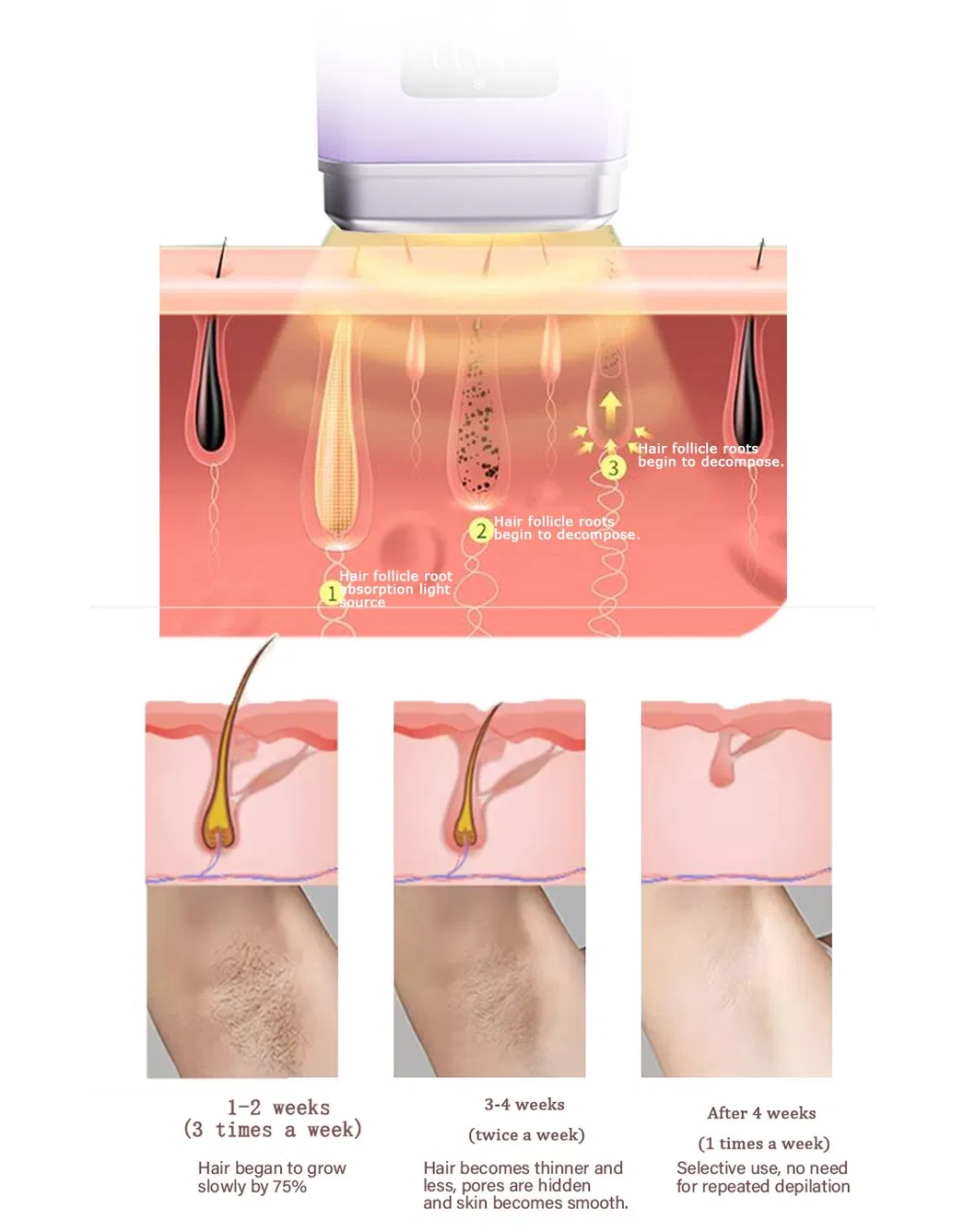 Professional Portable Permanent IPL Ice Hair Removal