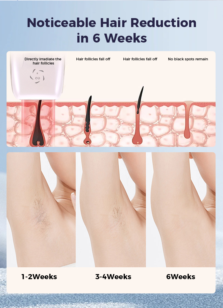 IPL Hair Removal Device View 9