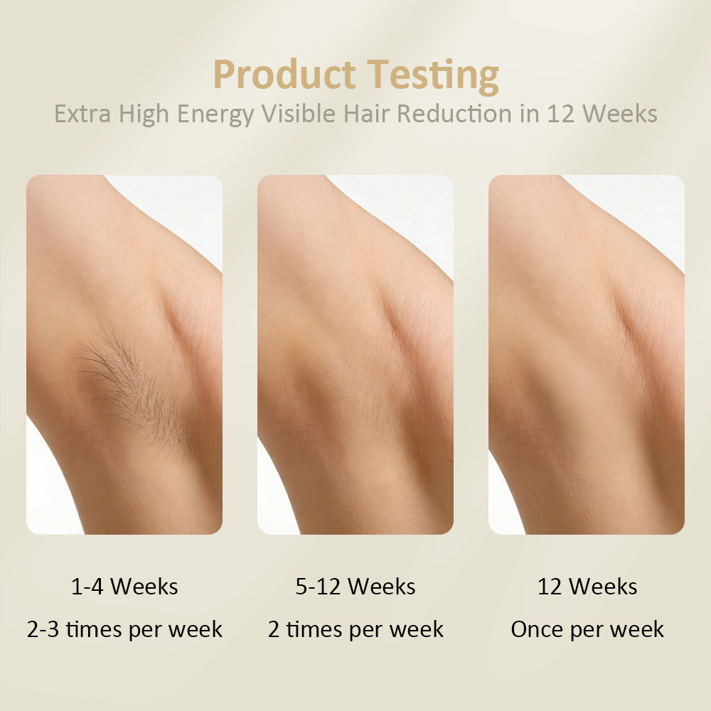 Custom 30J Handset Ice Cooling IPL Laser Hair Removal Device with Skin Tone Sensor and Fast Flashing for Body and Household Use
