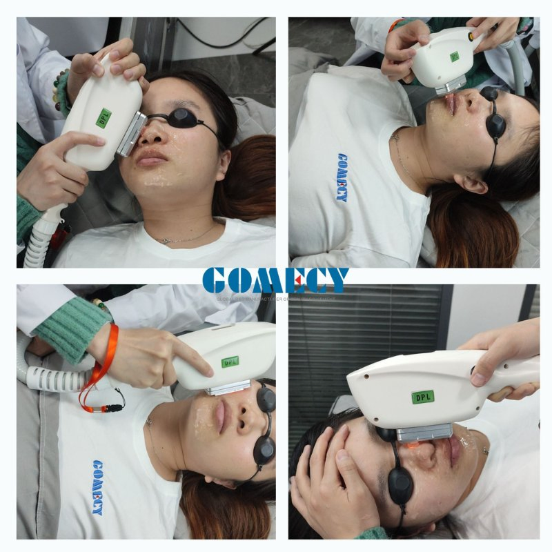 -25c Sapphire Cooling Dpl IPL Device for Non-Surgical Face Lifting