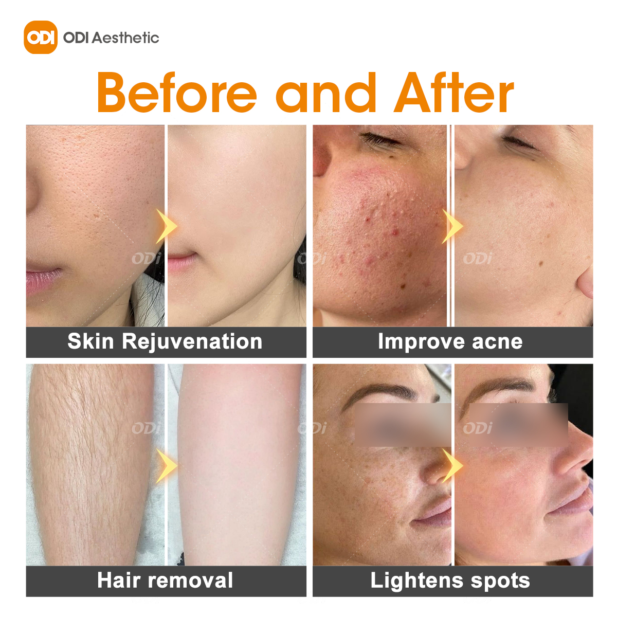 DPLIPL Remove Red Blood Dpl Photofacial Skincare Device Analy Painless IPLDPL Cooling Photofacial Skin Rejuvenation Machine
