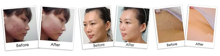 Medical Grade IPL Laser Face Treatment Hair Reduction Skin Rejuvenation Acne Vascular Pigment Removal Device