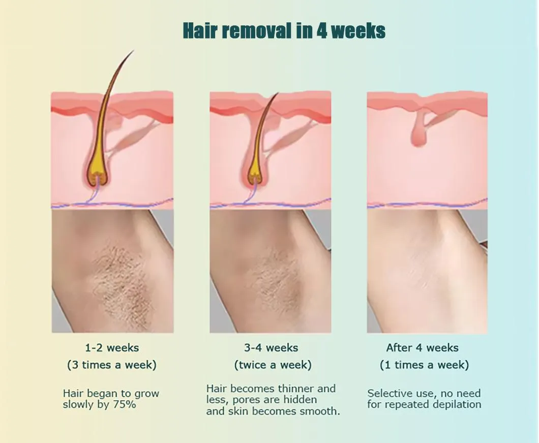 2024 New IPL High Quality Strong Pulse Laser Hair Removal Instrument