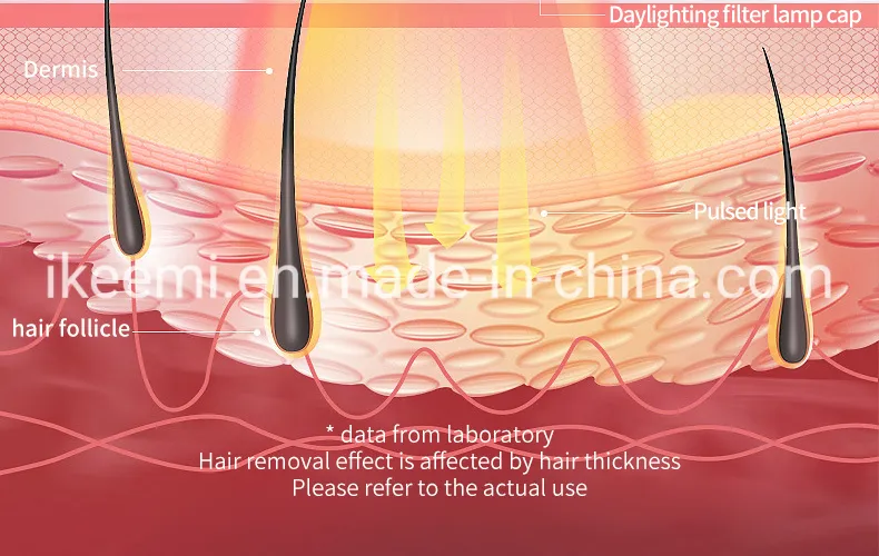 IPL Hair Removal Device Effectiveness