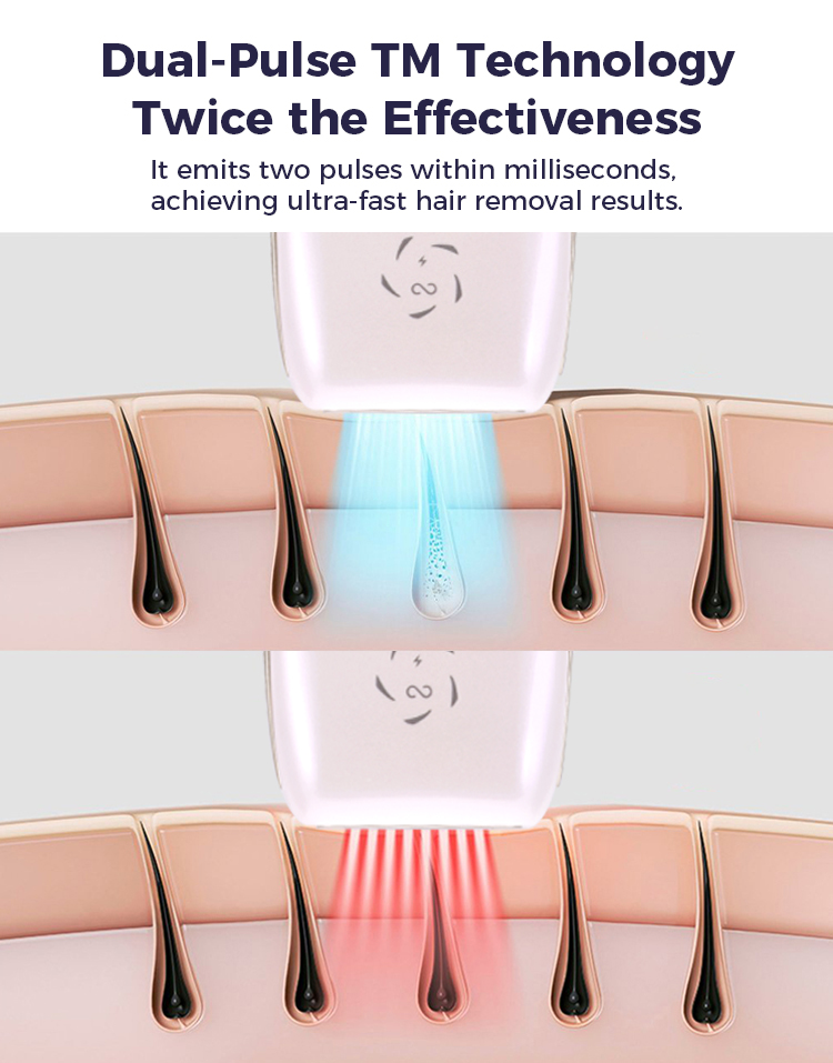 IPL Hair Removal Device View 6