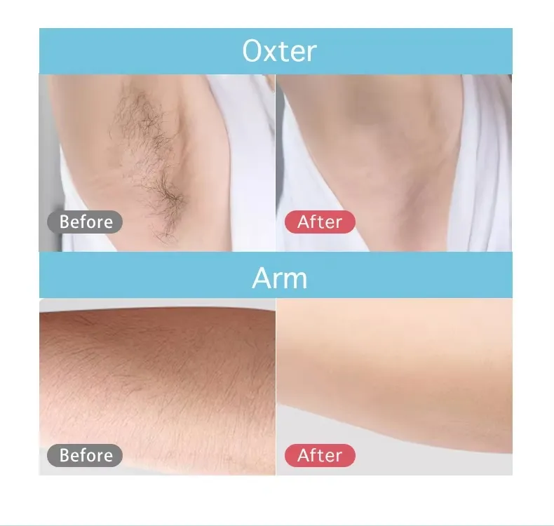 Painless 9000000 Flashes Home Use Machine Permanent Laser IPL Portable Full Body Hair Removal
