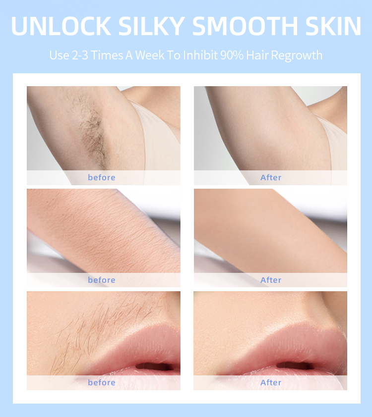 IPL Hair Removal Device View 5