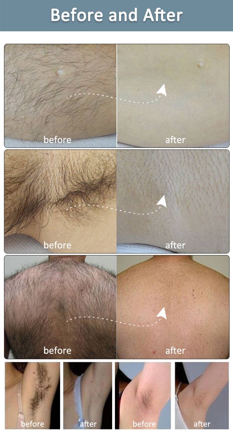 808nm 755nm 1064nm Wavelengths Diode Laser Hair Removal Machine for Women & Men