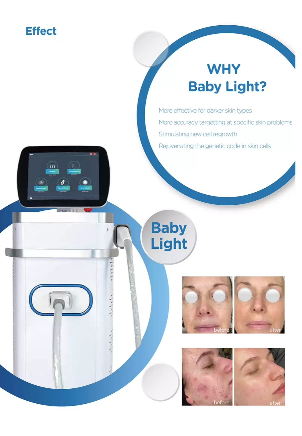 ADSS BBL Hero NIR OPT Broadband Light IPL Professional Hair Removal Skin Rejuvenation Machine CE MDR For Commercial Salon Clinic