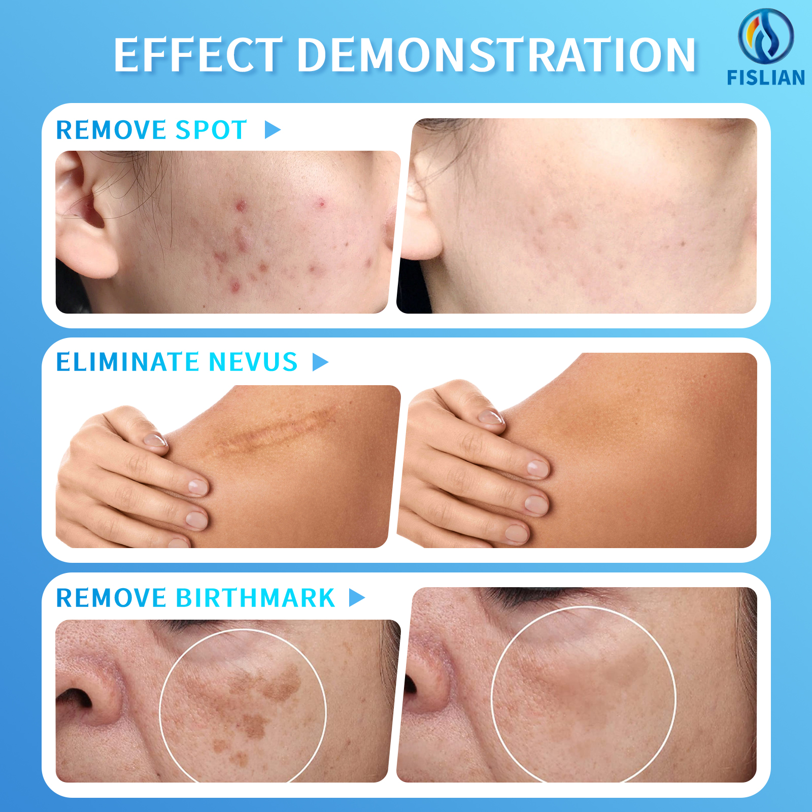 All-in-One Electrolysis Hair Removal System Portable Desktop Machine for Permanent Hair Removal on Face and Body