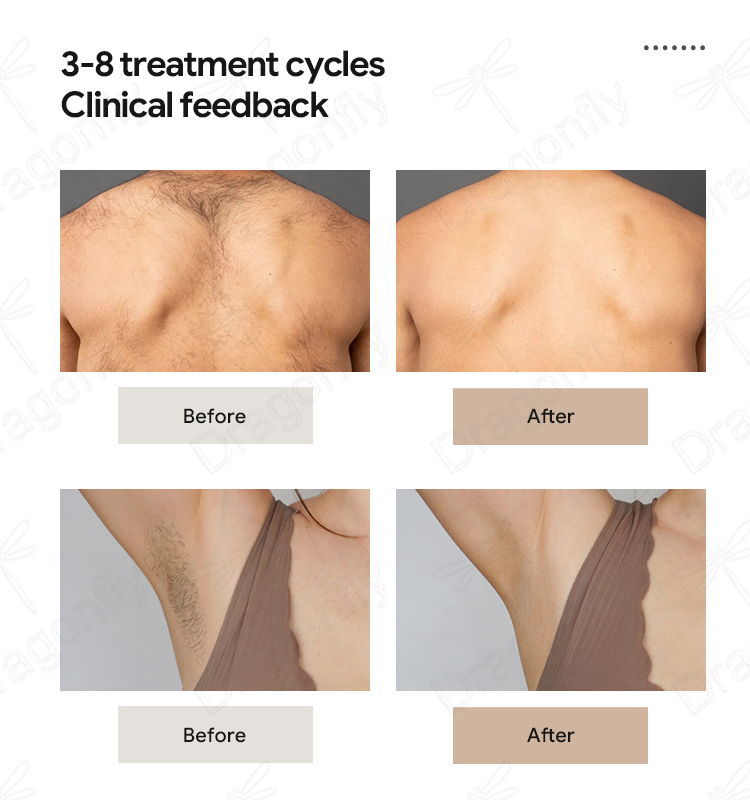 Laser hair removal treatment principle