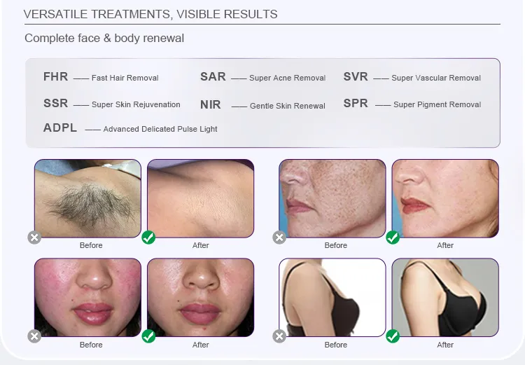 IPL Hair Removal Equipment Portable Intense Pulsed Light Depilator Dpl Vascular Removal Skin Rejuvenation Beauty Device