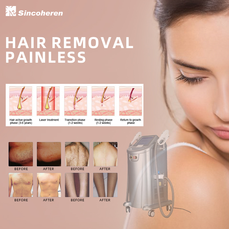 2023 Hot Selling IPL Laser Machine Skin Rejuvenation and Hair Removal Device