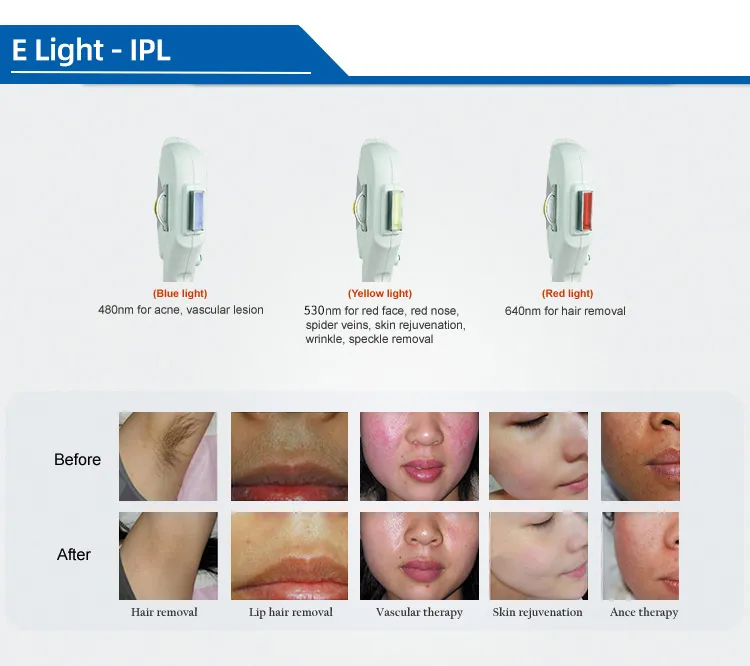 IPL Elight Laser Configuration