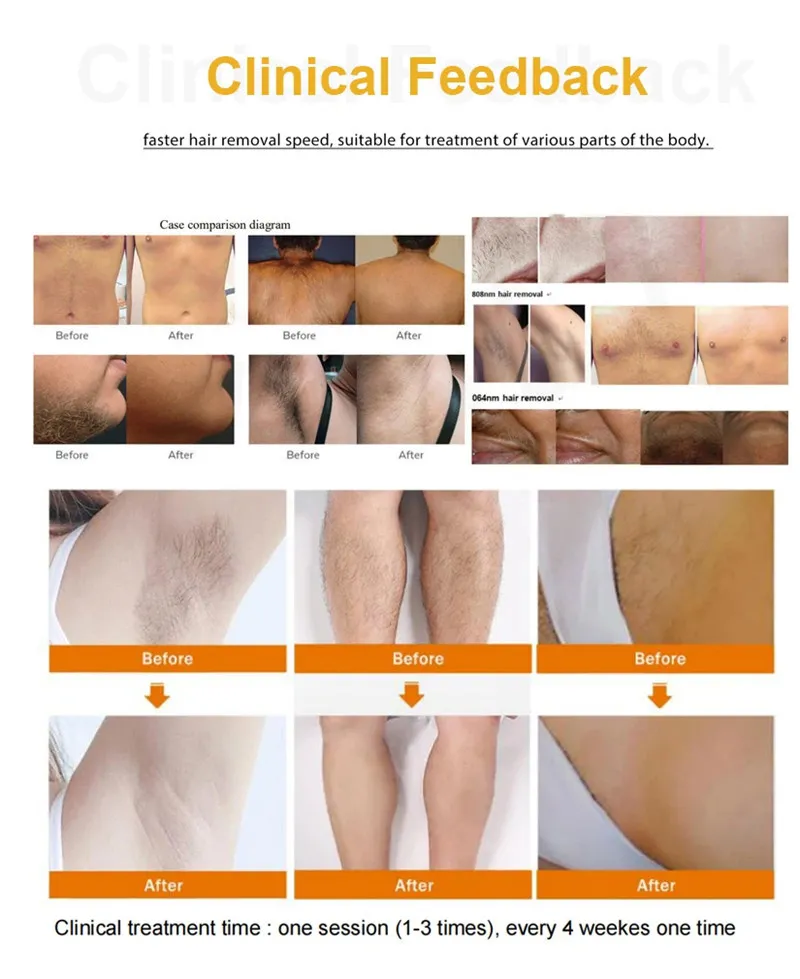 Laser Diode Hair Removal 1