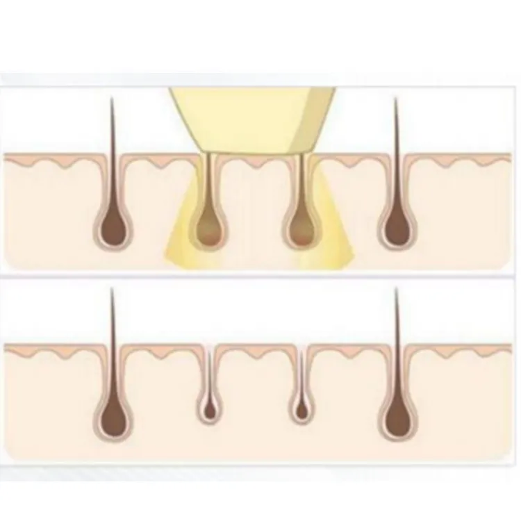 Hair Removal Treatment Principle