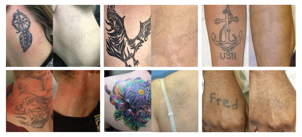Laser Treatment Results