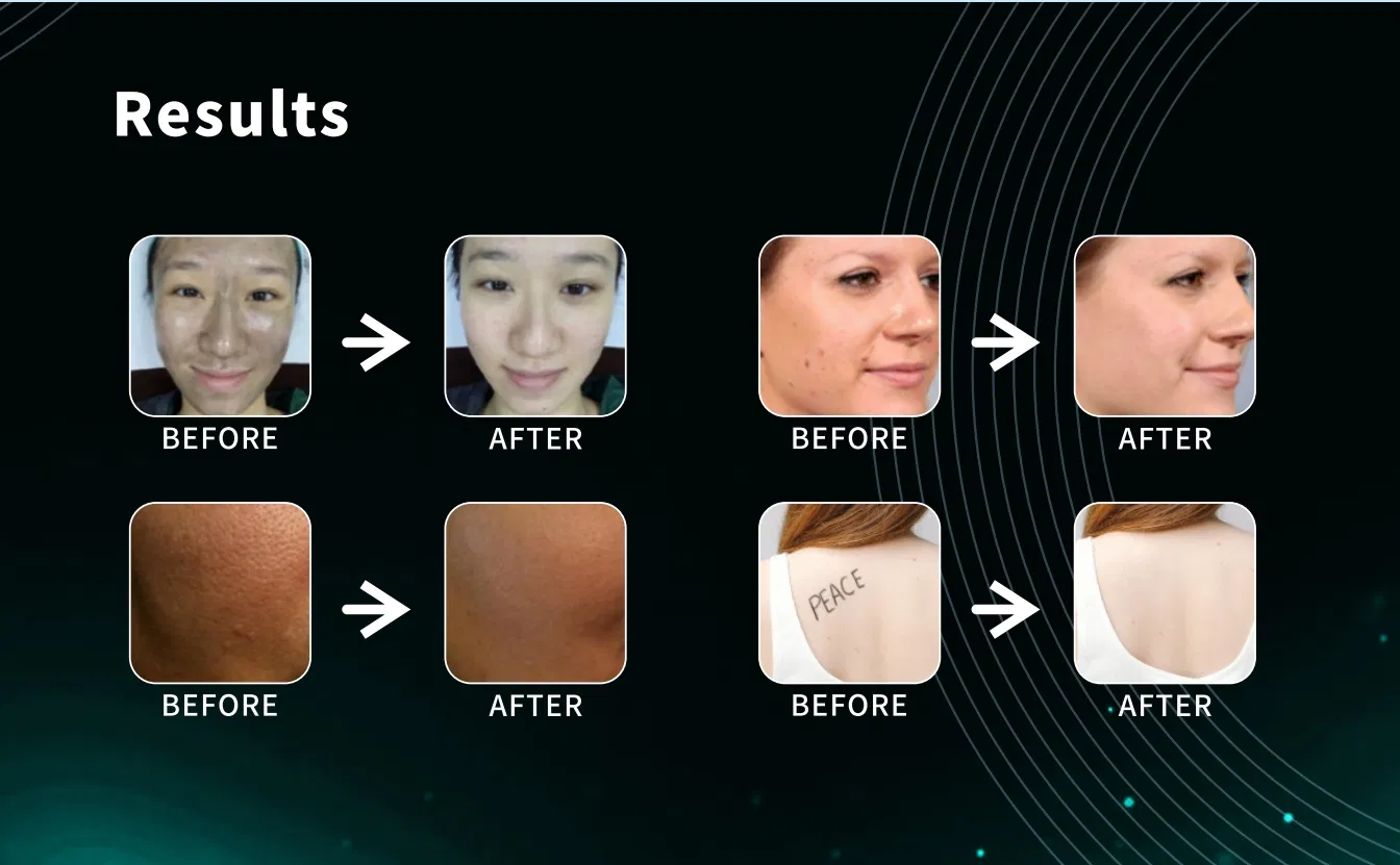 Diode Laser & ND YAG Laser Beauty Device for Hair/ Tattoo Removal