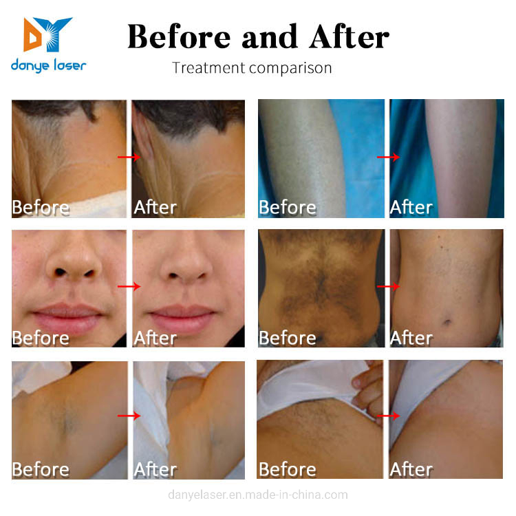 Laser Machine Germany 808 Diode Laser Permanently Hair Removal Home Device Hong Kong