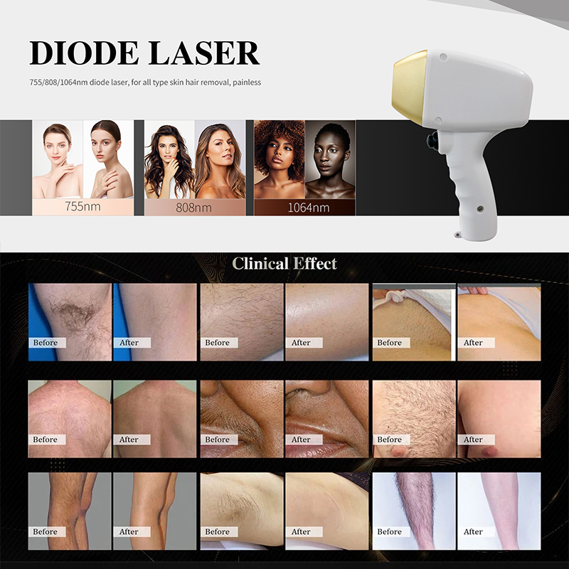 2025 Portable Q-Switch Laser Tattoo and Hair Removal Device Diode Laser Picosecond Alexandrite Laser