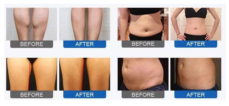 Pressotherapy Before and After Results