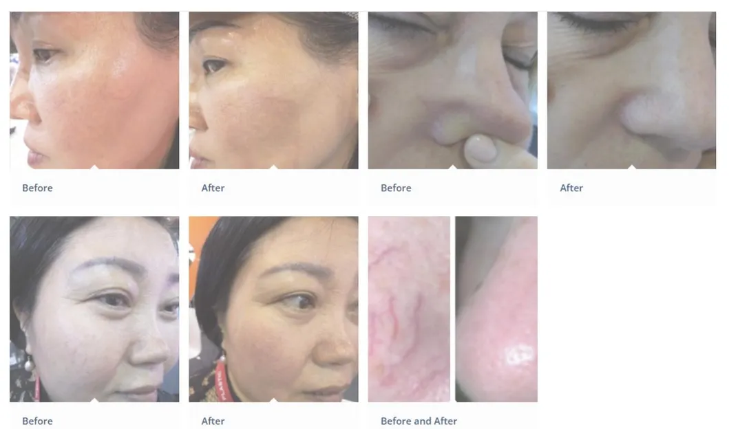 Before and After Treatment Photo