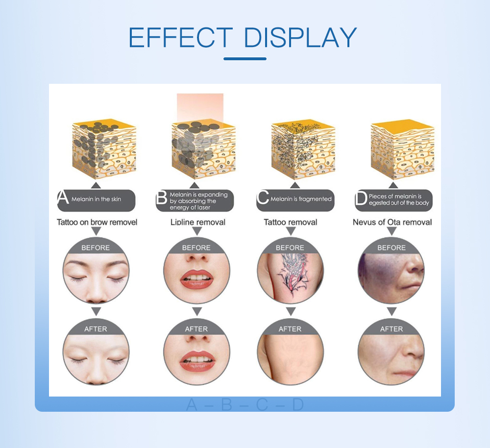 Hot Sales 7 Languages Tattoo-removal Blackhead Removal Carbon Peel Picosecond-laserings Portable Machine