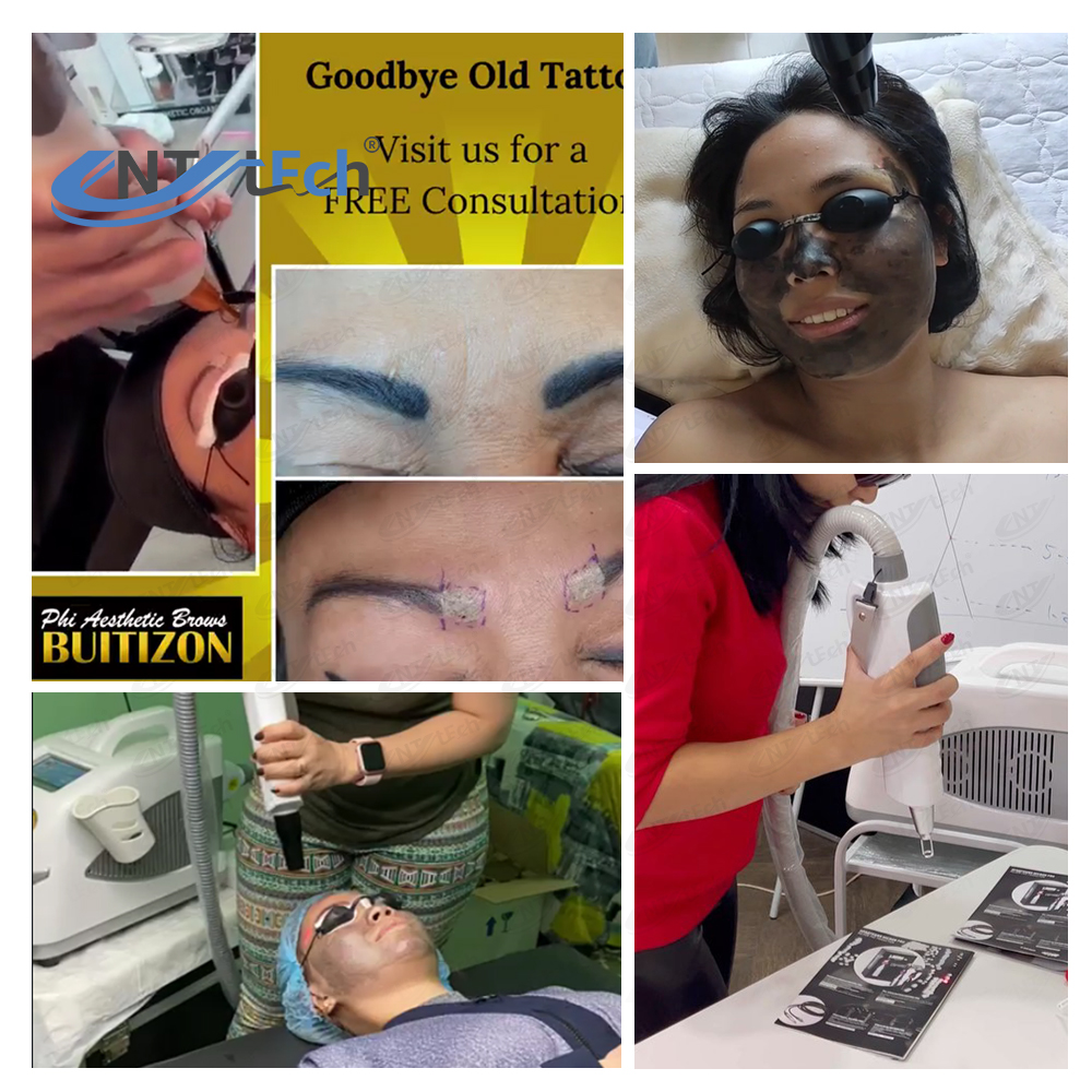 Mini Portable Picosecond Carbon Laser Peeling Tattoo Removal Machine Q-Switched Nd Yag for Commercial Use