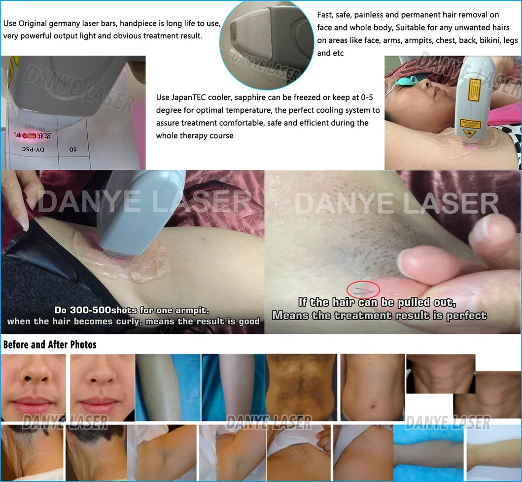 808 Diode Laser Treatment Advantages Before and After Photos