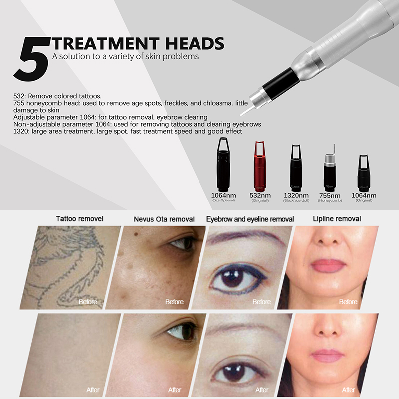 2025 Portable Q-Switch Laser Tattoo and Hair Removal Device Diode Laser Picosecond Alexandrite Laser