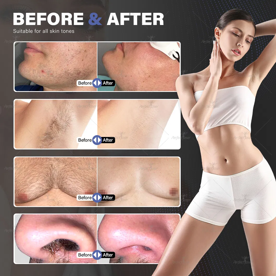 Customizable Ice Diode Laser 808nm Hair Removal Beauty Device