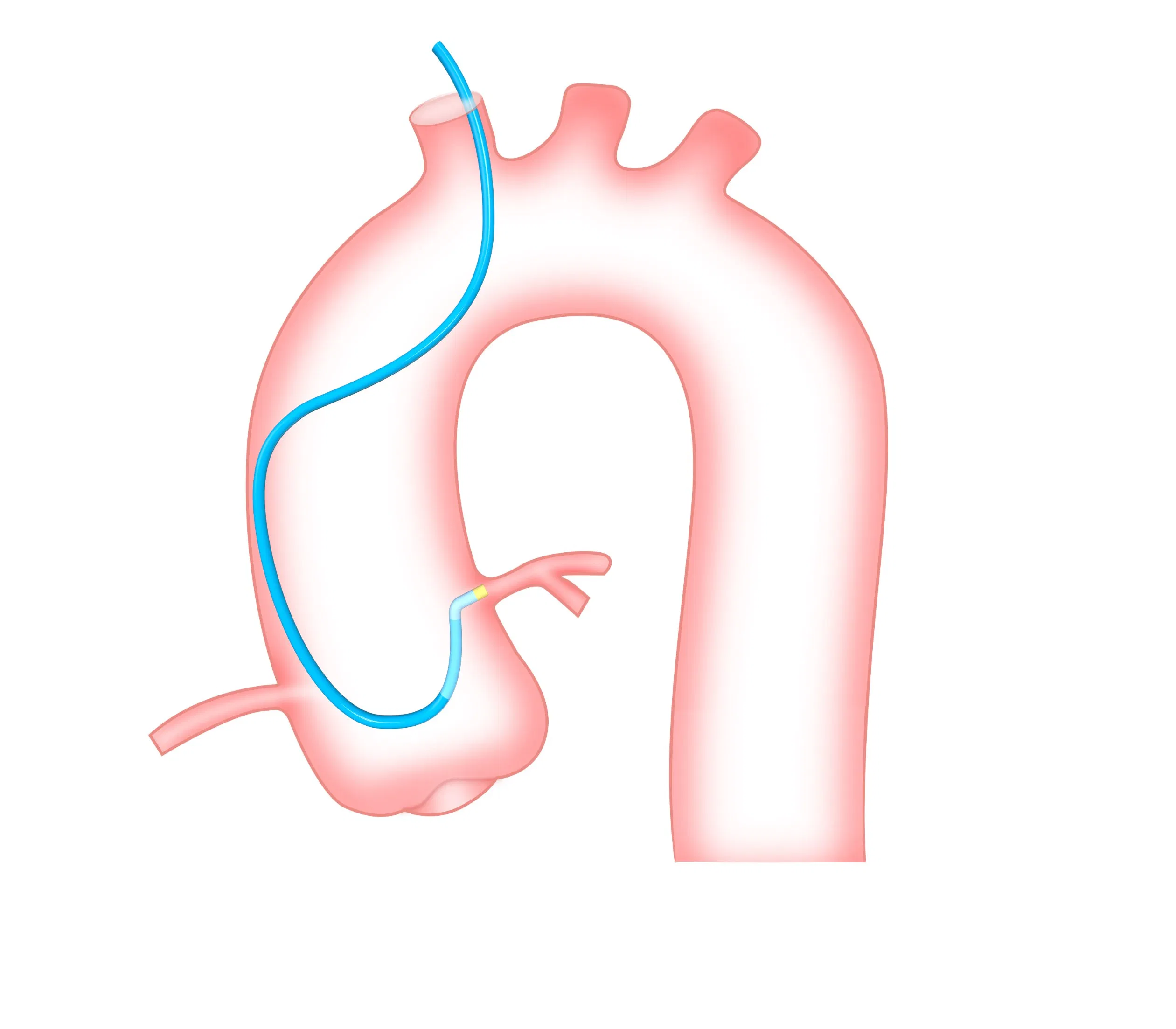 Catéter guía coronario hidrofílico CE para PCI con fuerte soporte de respaldo