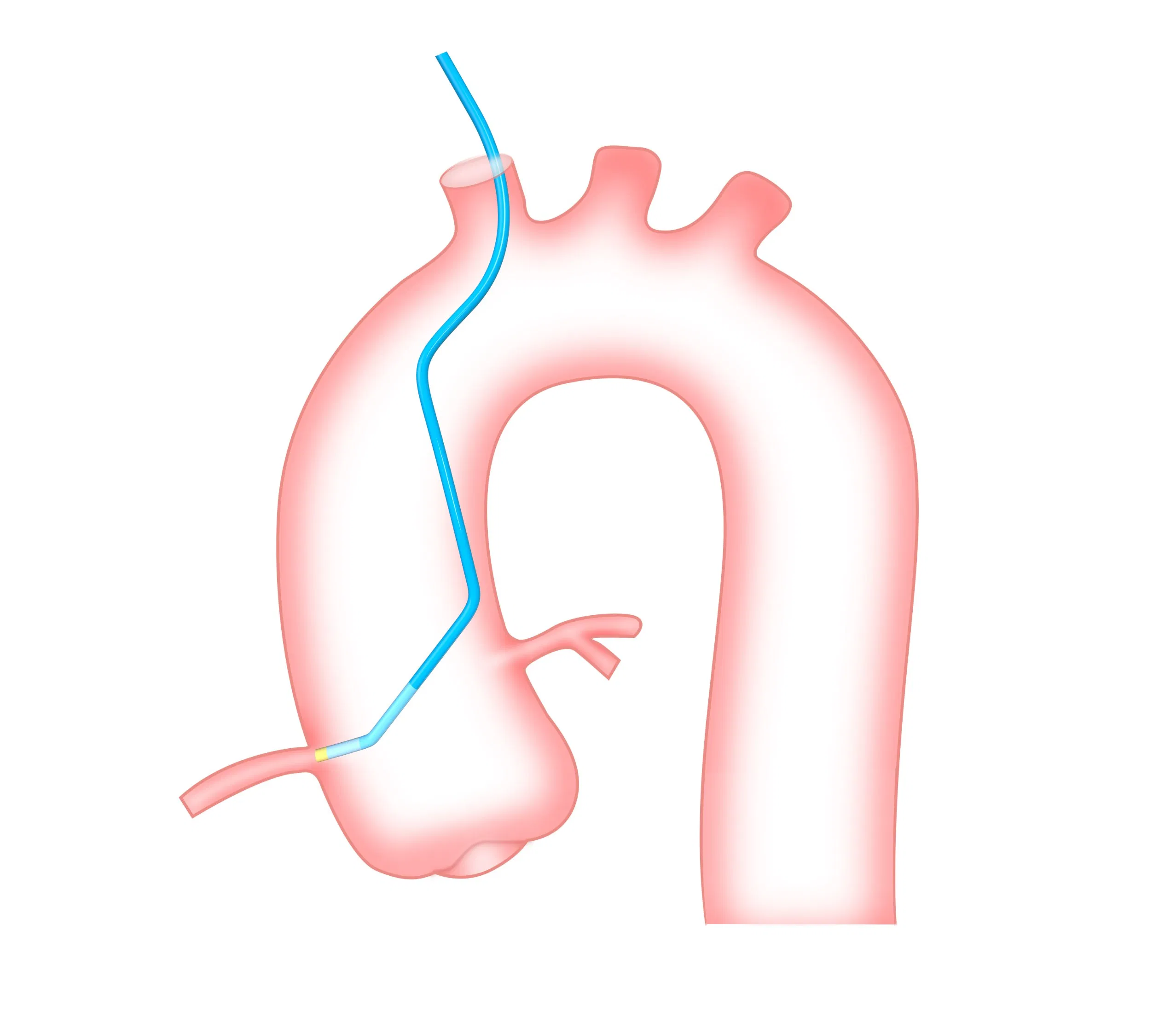6f 7f 8f Catéter guía de alta soporte recubierto de hidrofílico dispositivo de cardiología intervencionista