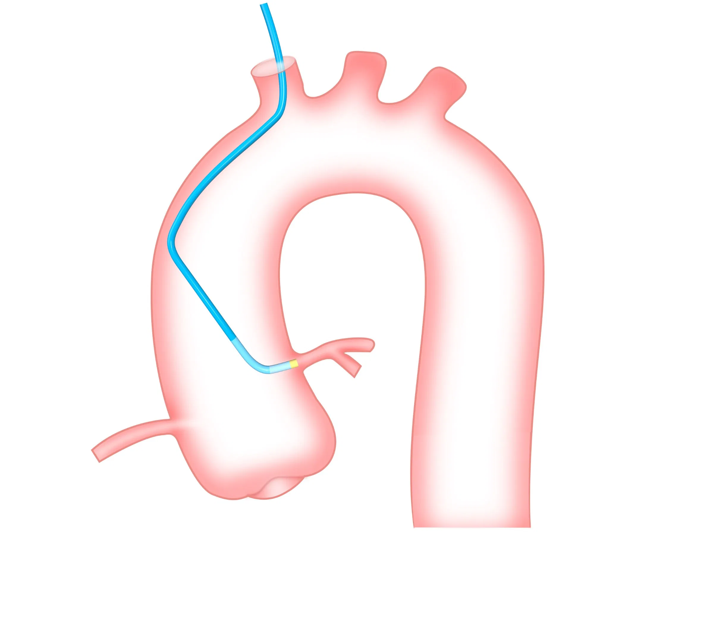 6f 7f 8f Catéter guía de alta soporte recubierto de hidrofílico dispositivo de cardiología intervencionista